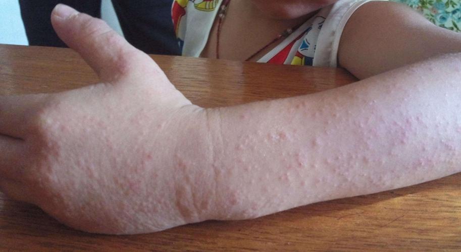 螨虫过敏症状引发结膜炎图片