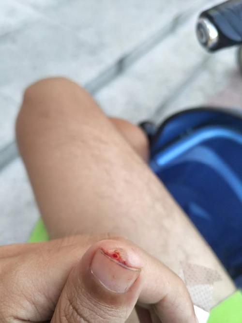 刺猴拔出来了,一个深坑.