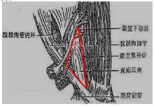 (有助于记忆)(2)腹股沟直疝:疝囊从腹壁下动脉内侧,经腹股沟三角区