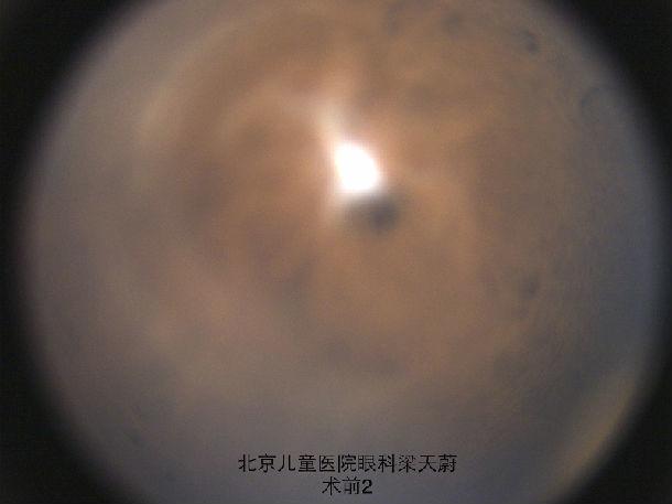宝宝瞳仁发白就是先天性白内障吗? (原创)