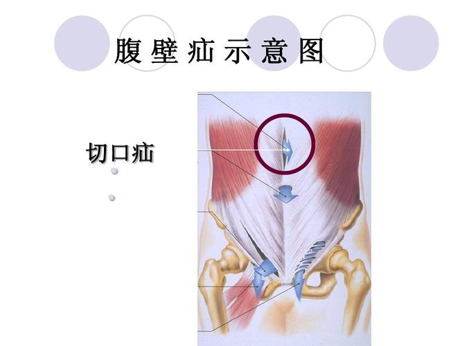 腹壁疝示意图 切口疝