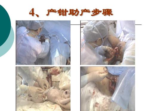 产钳助产术