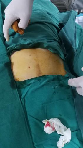 子宫肌瘤消融治疗