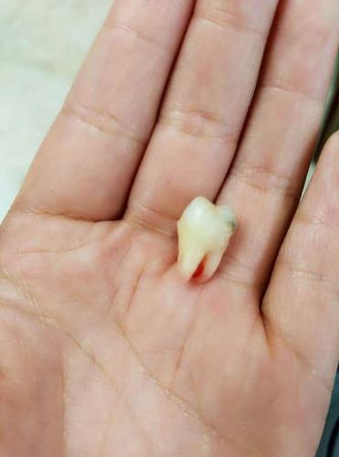 什么样的智齿一定要拔掉?