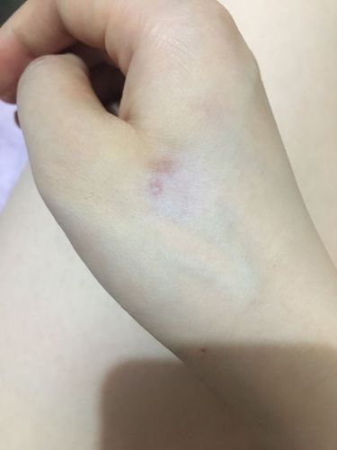 各大医院都看过,没效果,后来听熟人介绍去打针,是局部注射,就是手上