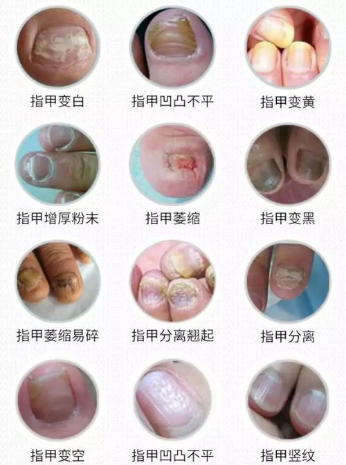 得了灰指甲,难治吗?