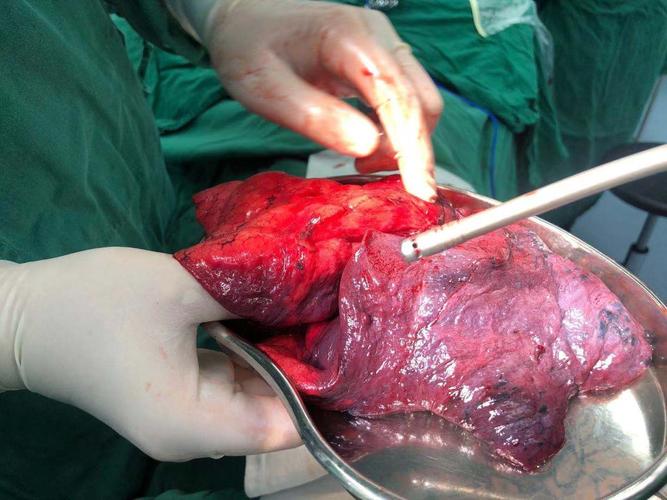 我院外四科完成首例右全肺切除术