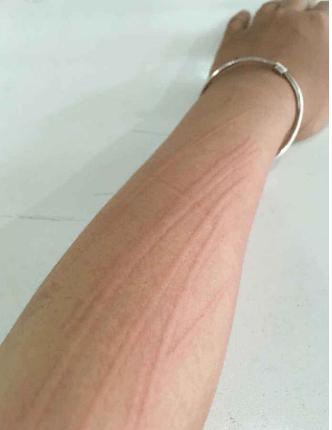 在皮肤上轻轻一划就会出现凸起的红印子?注意!可能是得了这个病!