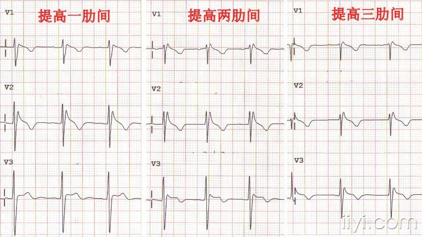 brugada综合症? - 心电图脑电图专业讨论版 - 爱爱医