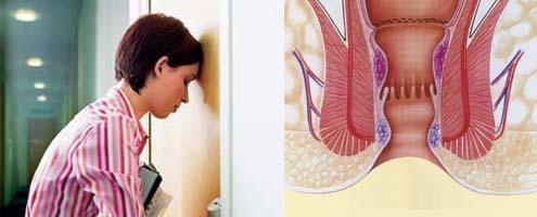 如肛门湿疹,神经性皮炎,癣,各种疣,性病,汗腺炎等,粪便附于肛门皱襞内