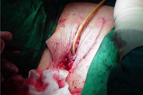 变性手术图片_百度百科