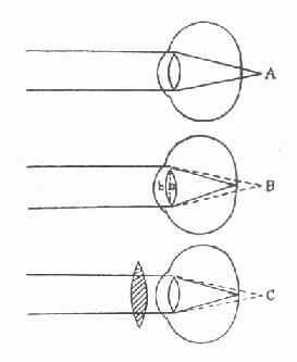 屈光不正是什么意思