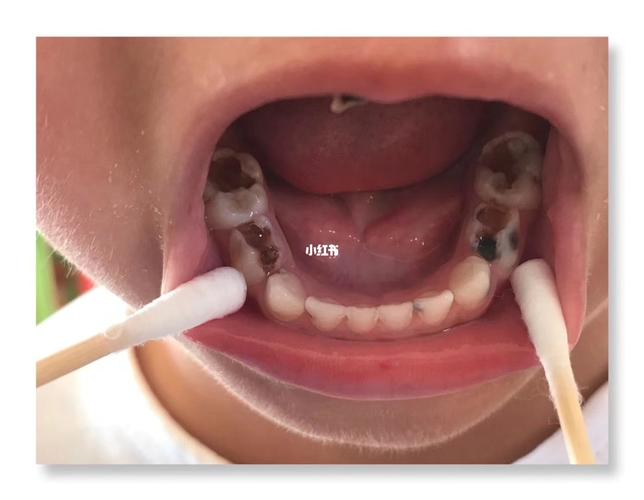 乳牙龋齿# 蛀牙应该以预防为主_蛀牙_汪万年口腔学院