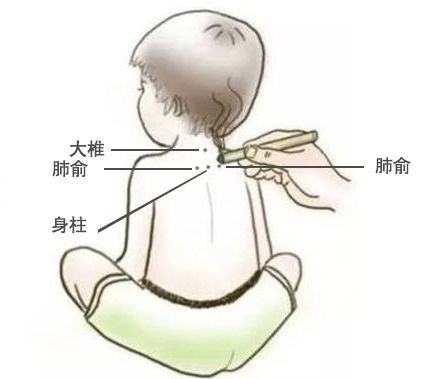 小儿发烧感冒咳嗽 我的艾灸推拿经验分享篇