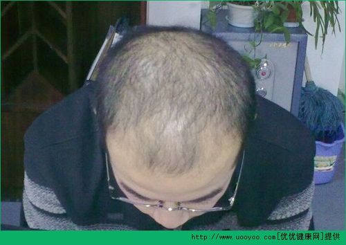 男性脱发的表现是什么?[多图]