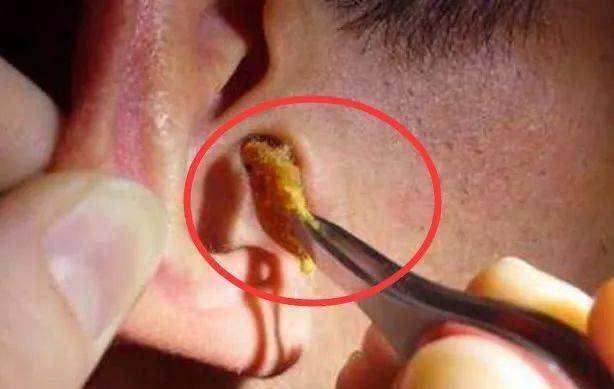 油耳朵是外耳道皮肤的顶泌汗腺分泌较旺,使耳垢表现为黄色柔软稀薄