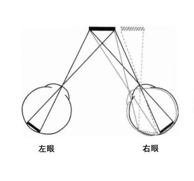 单眼性复视(遮盖一眼时可看到复视)主要为屈光不正;两眼性复视(遮盖
