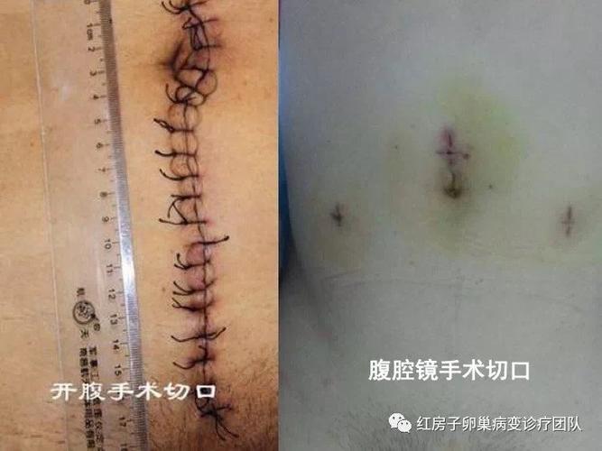 纤毫毕现 微创让卵巢癌手术更精准也更温柔