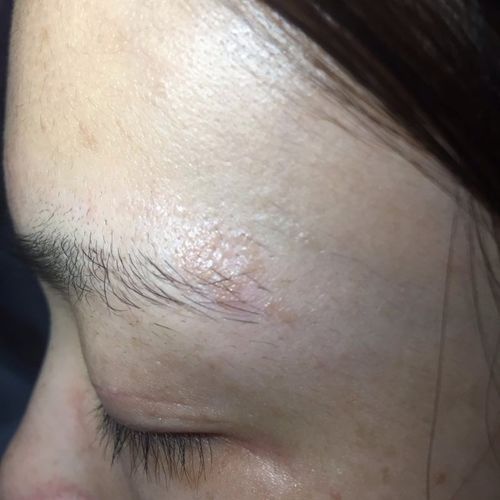 请问眉毛末端那些个像皮癣一样的东西是什么