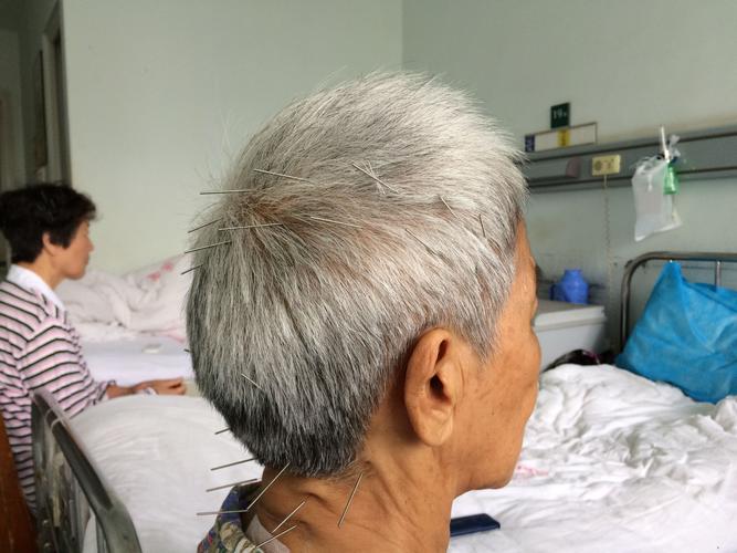 焦顺发头针运用体会