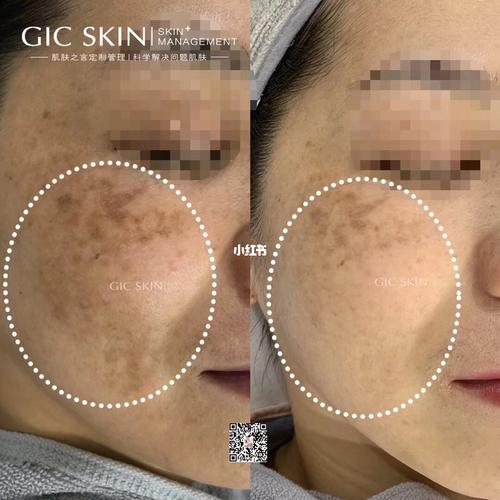 黄褐斑,真皮斑修复_黄褐斑_淡化色斑_祛斑_美妆_护肤