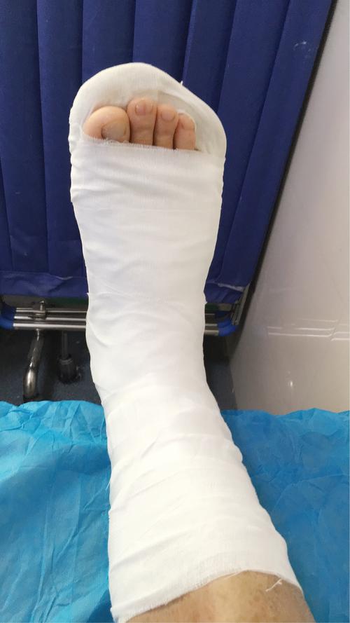 【暖心服务】石膏固定后的注意事项