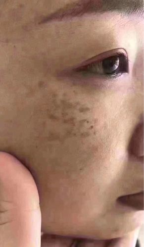 真皮斑第二期:太阳穴