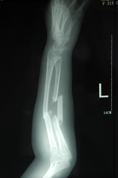 拍摄的吴菊萍受伤左臂的x光片,医生诊断为手臂左尺桡骨多段粉碎性骨折