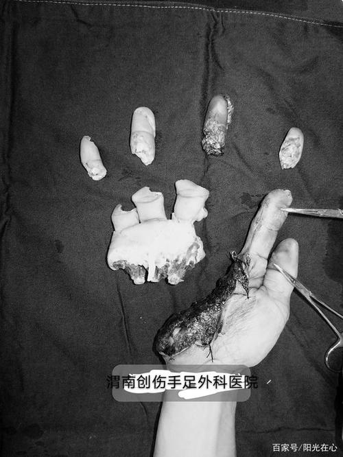 18个小时!刘林峰挽救一只断成七截的手