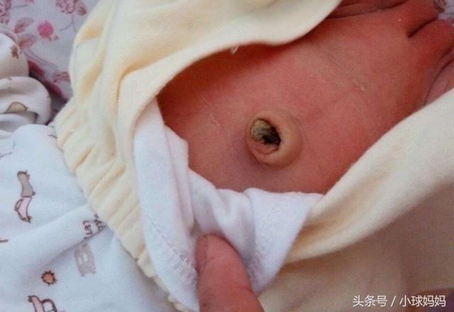 2,肚脐,宝宝一出生医生把脐带减掉,会让宝宝的肚脐出现血迹,家长们要