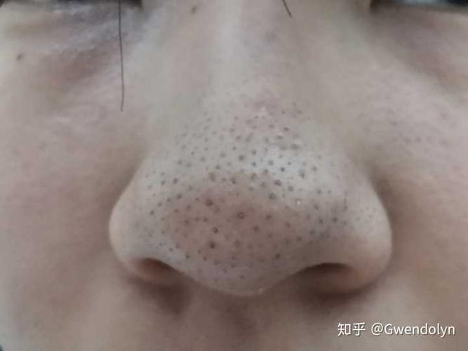 女孩子鼻子上有黑头很自卑,大家怎么处理的啊?