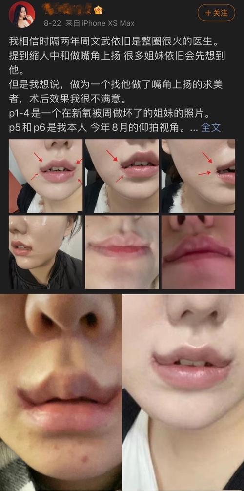 嘴唇上扬失败案例出自同一位医生71不敢相信60