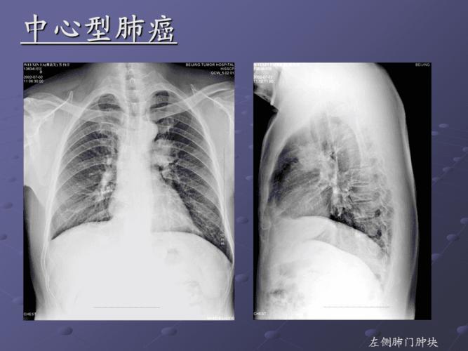 肺癌影像诊断讲课