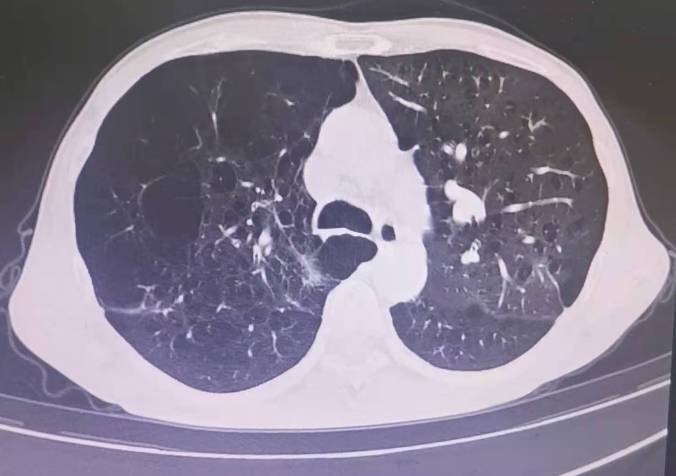 ct片示徐大叔多发肺大泡形成