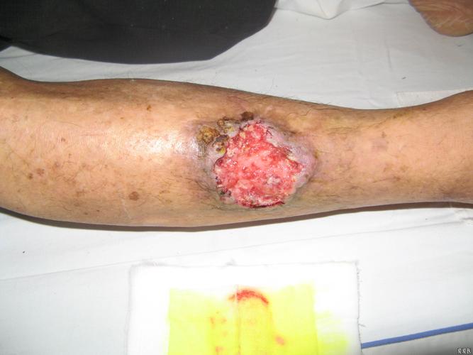 病例讨论右小腿慢性溃疡癌变