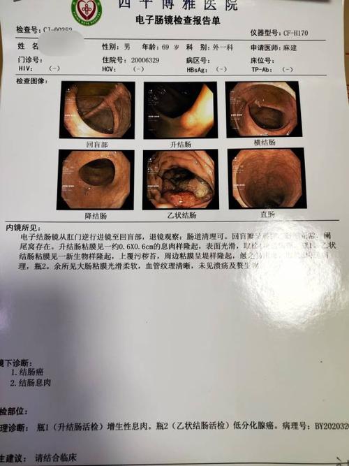 肠镜显示乙状结肠肿瘤,后活检证实为乙状结肠低分化腺癌.