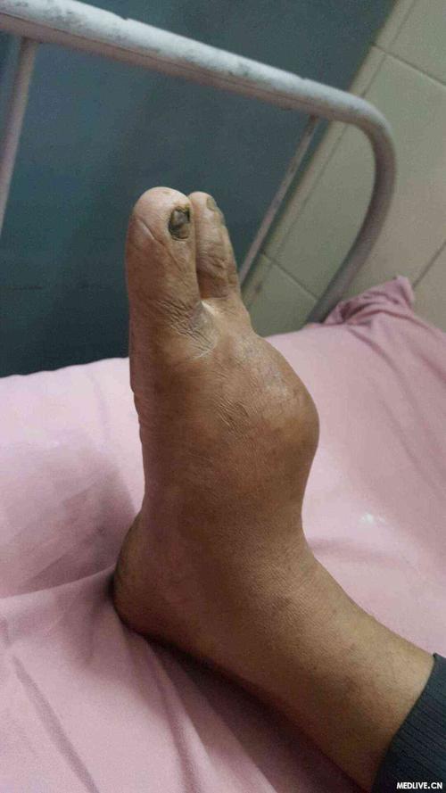 应该怎样治疗?