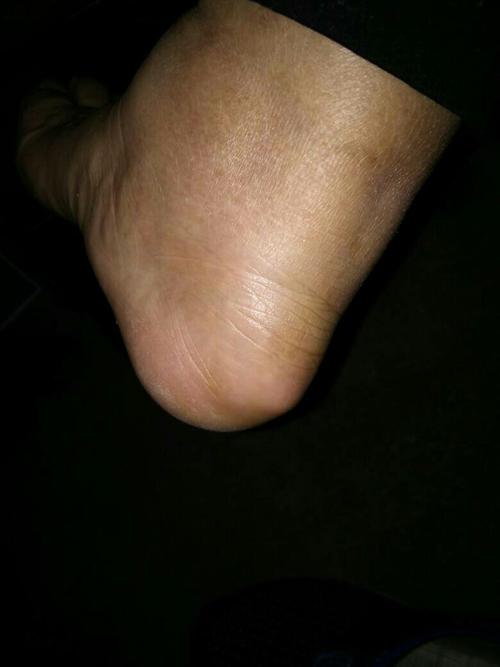 脚后跟脚后跟突出来了一个包.