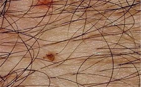 女性得阴虱早期图片