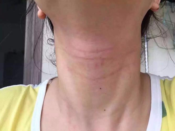 戴项链就出现这样的红点点,好痒,用什么东西擦?