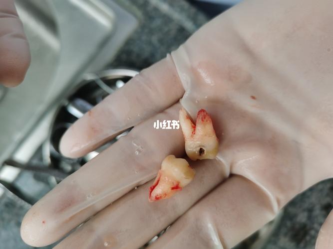 再见了,我的智齿!