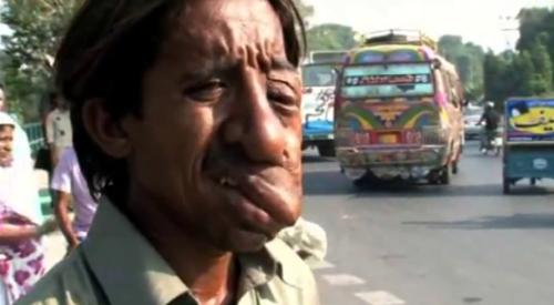 父母近亲结婚他天生畸形,他和堂姐结婚生下怪胎