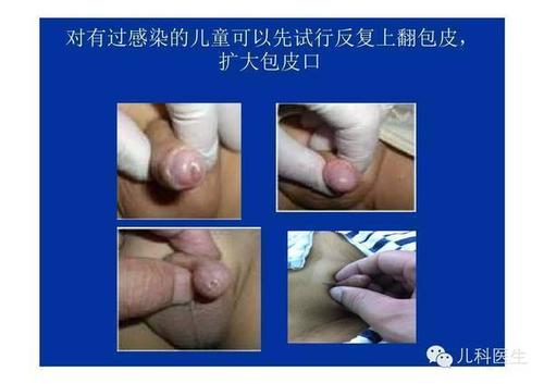 包茎的治疗应在3岁后开始翻包皮训练:儿童尽量背部靠墙壁直立,拇指和
