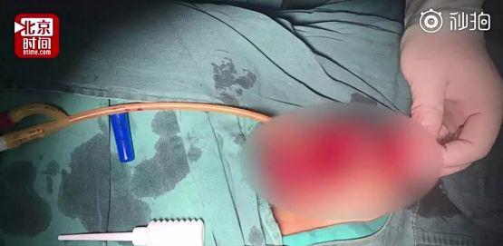 18 岁男生挥刀自宫!断成4块竟没哭没喊