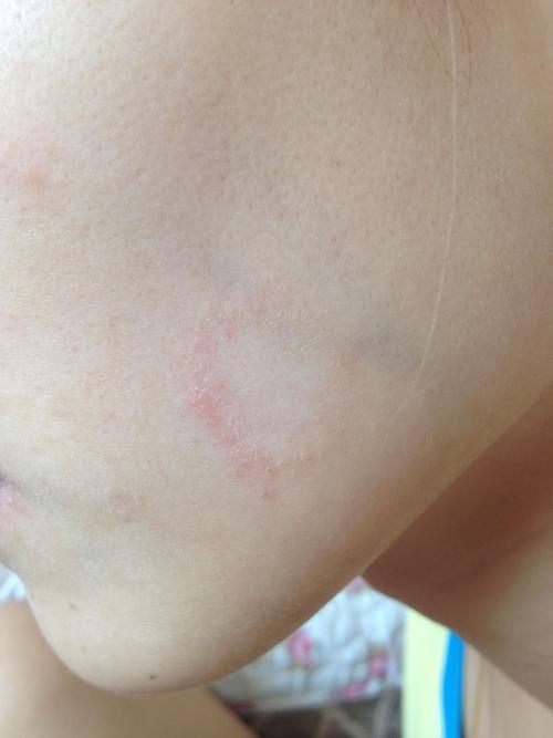 圈状红疹还是癣?