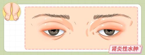 水肿究竟是什么病引起的?肾病,心脏病,肺病还是肝病?