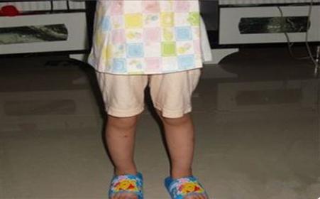 佝偻病临床分期与分度