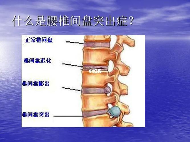您什么突出?是腰间盘么