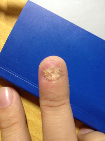 大半个月前做了拔甲手术,现在指甲的部分只