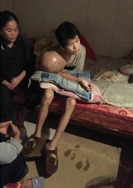 富宁县第一中学14岁少年右肱骨上段患骨肉瘤肿大如篮球无钱治疗